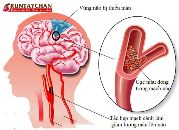Hội chứng Parkinson sau tai biến do thiếu máu, tắc mạch não